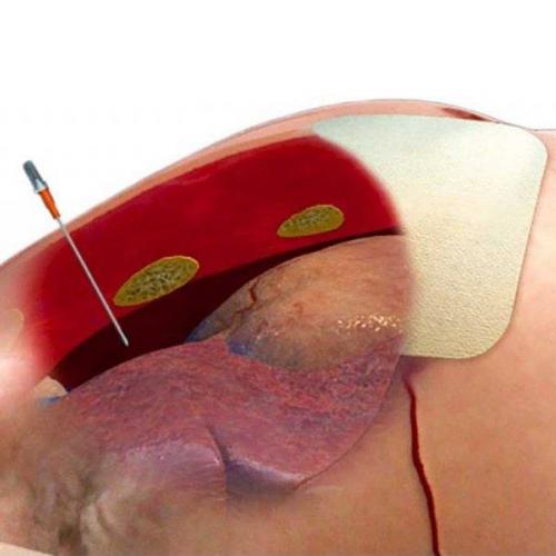 Голка декомпресійна NAR® "ARS® Decompression Needle 14ga", NAR-ARS